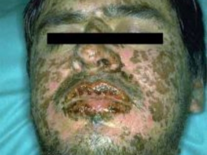 stevens Johnsons syndrome