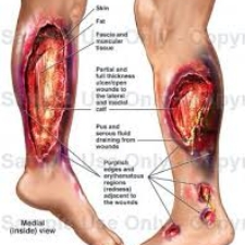 แบคทีเรียกินเนื้อคน