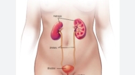 cystitis