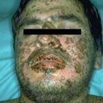 ผื่นแพ้ยา Stevens Johnsons syndrome