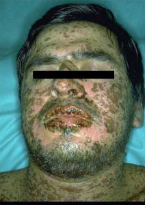 stevens Johnsons syndrome